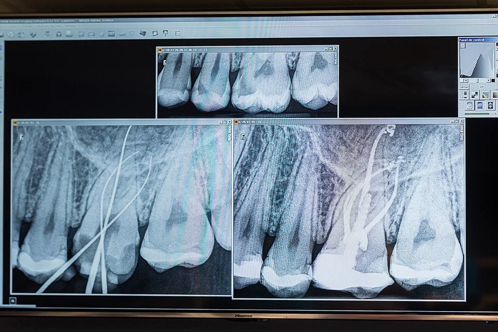 tratamientos-endodoncia