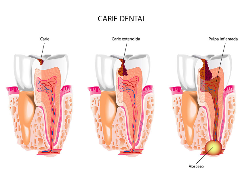 Caries dental