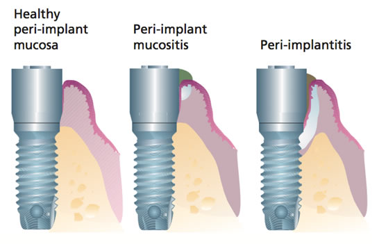 mucositits-perimplantitis