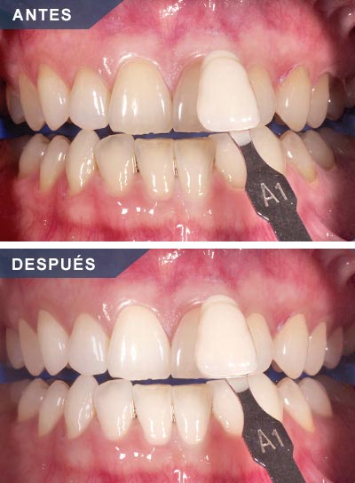 blanqueamiento-antes-despues