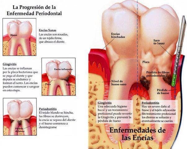 Progresión de enfermedad de las encías