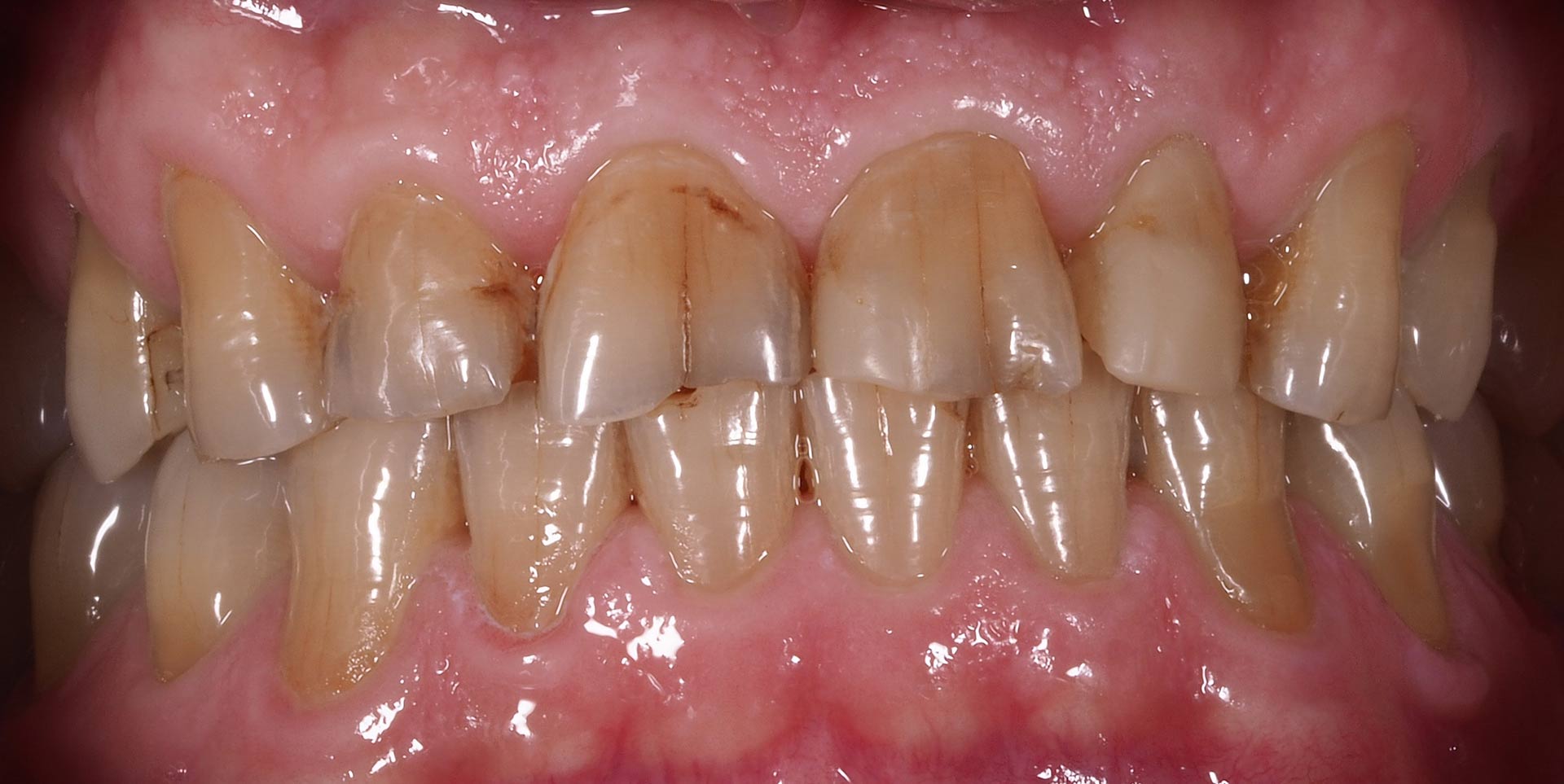 coronas-dentales-caso-clinico