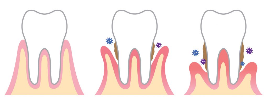 gingivitis periodontitis zaragoza