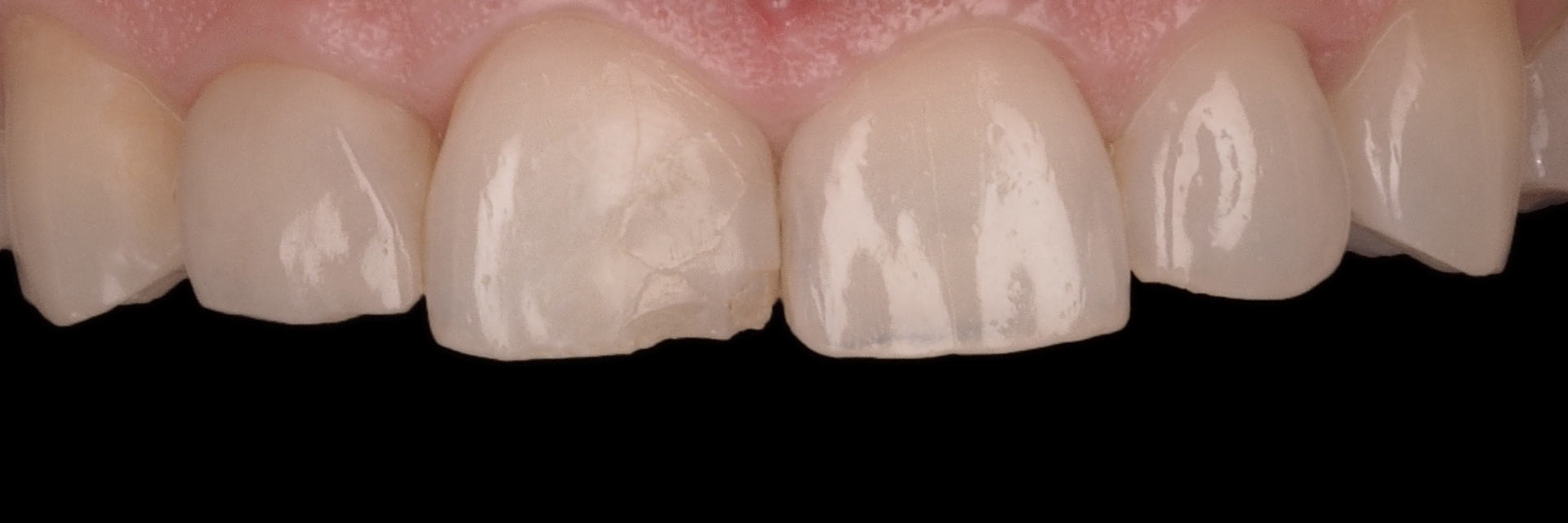 Caso Clínico Carillas dentales - Antes