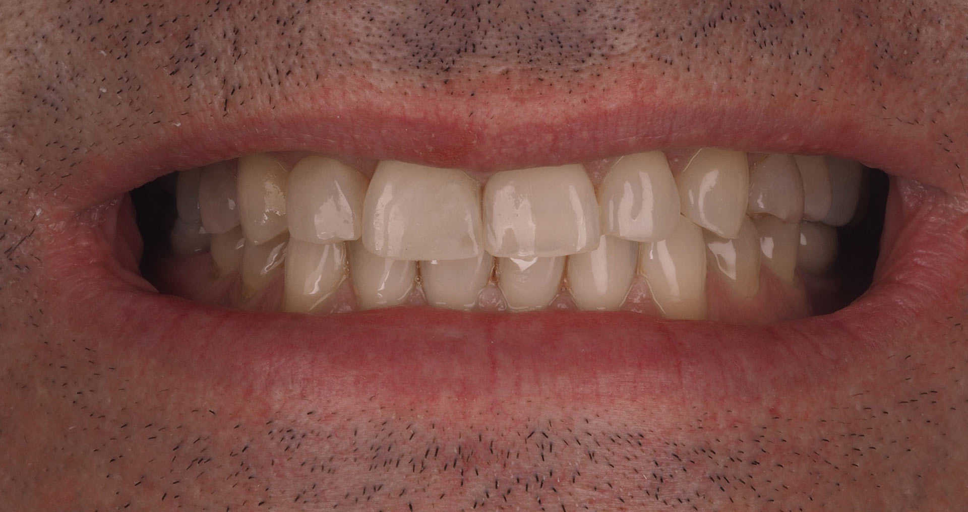 Caso clínico carillas dentales