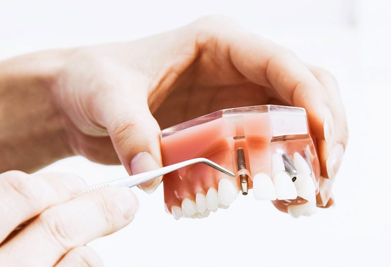 Proceso de osteointegración implantes dentales