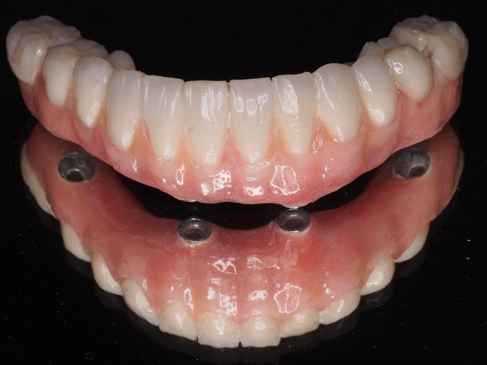 Prótesis dental fija inferior