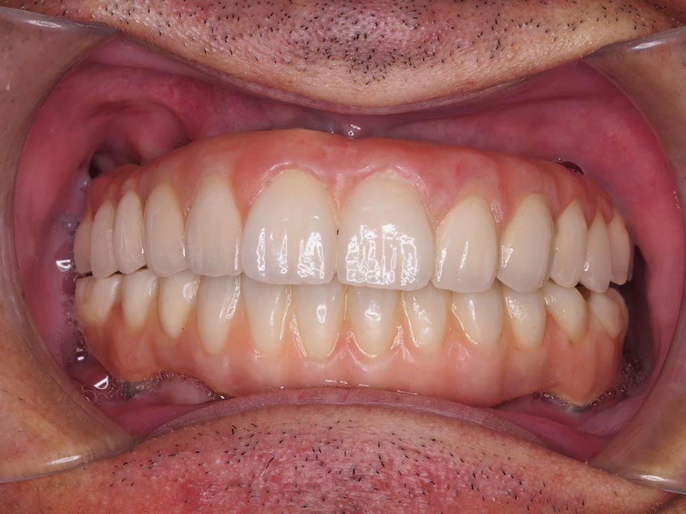 Resultado de prótesis dental fija