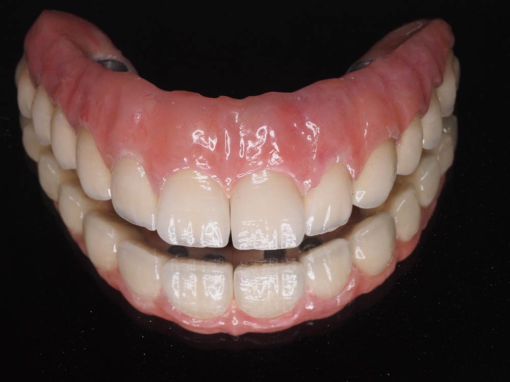 Prótesis dental fija superior