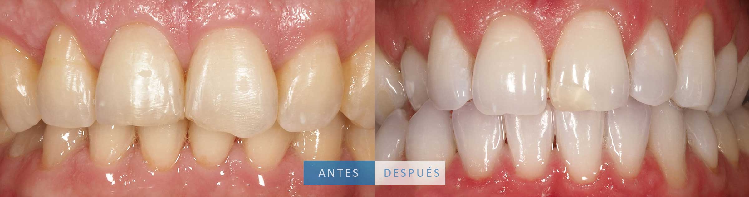 Caso de reconstrucción dental y blanqueamiento