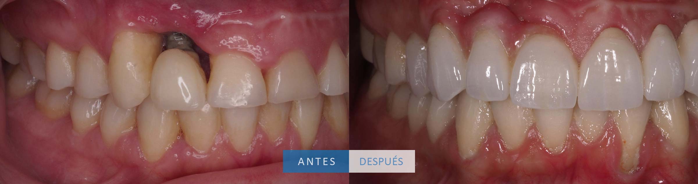 Caso clínico Loscos coronas dentales