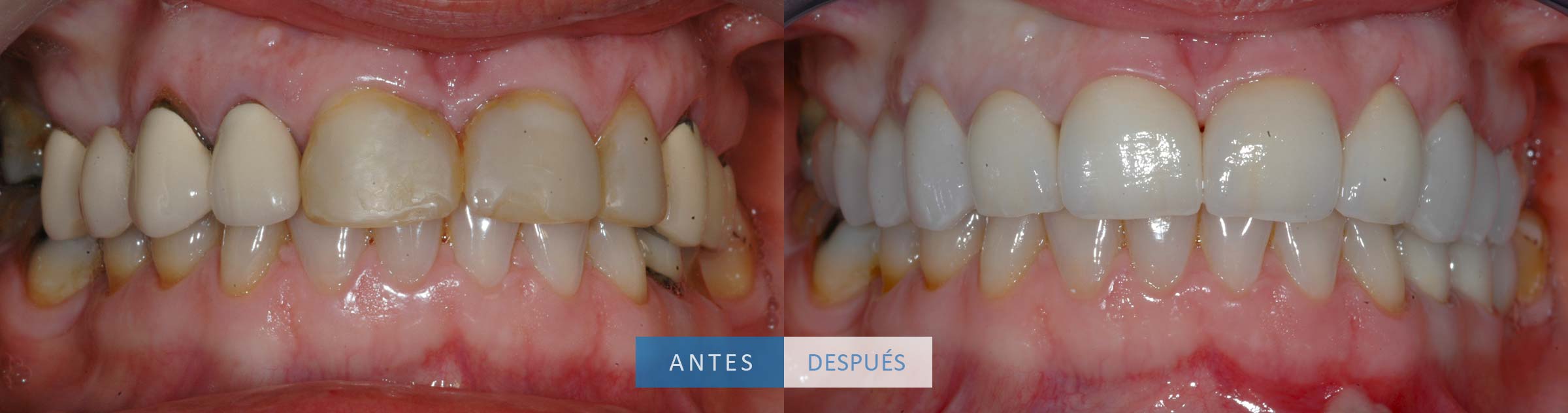 Resultado coronas dentales