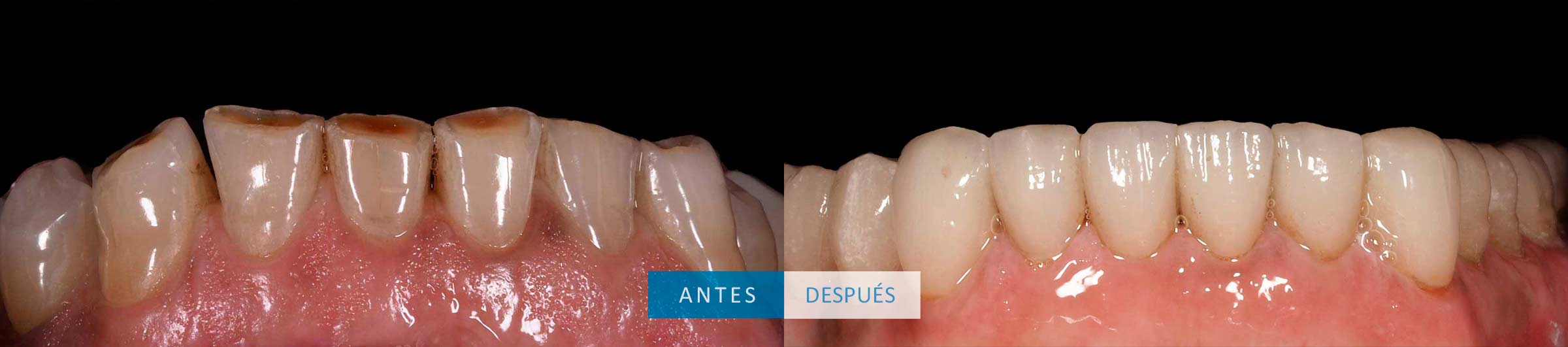 Dientes inferiores tratamiento con coronas dentales