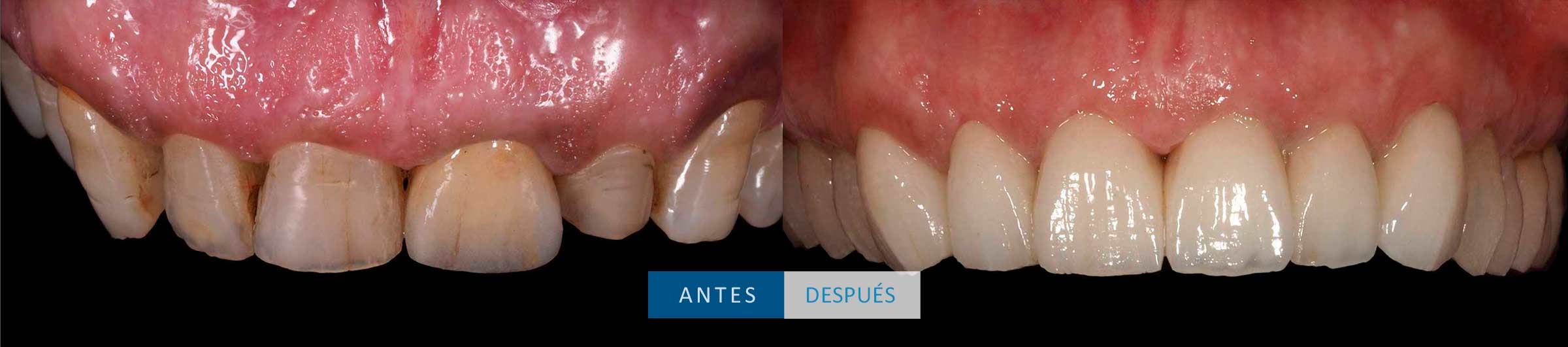 Dientes superiores tratamiento coronas dentales