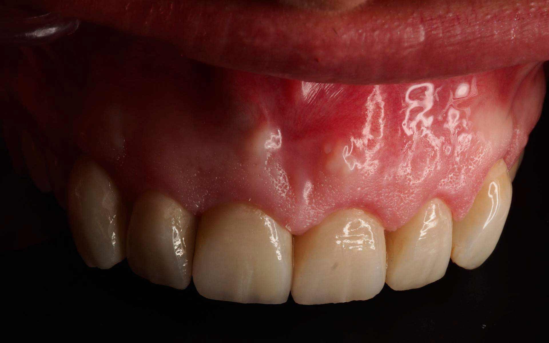 Frontal carillas dentales