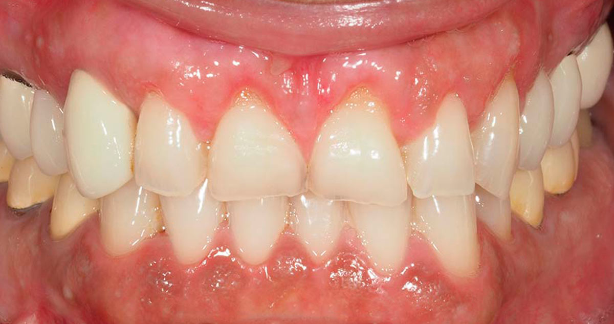 Microcirugía tratamiento gingival