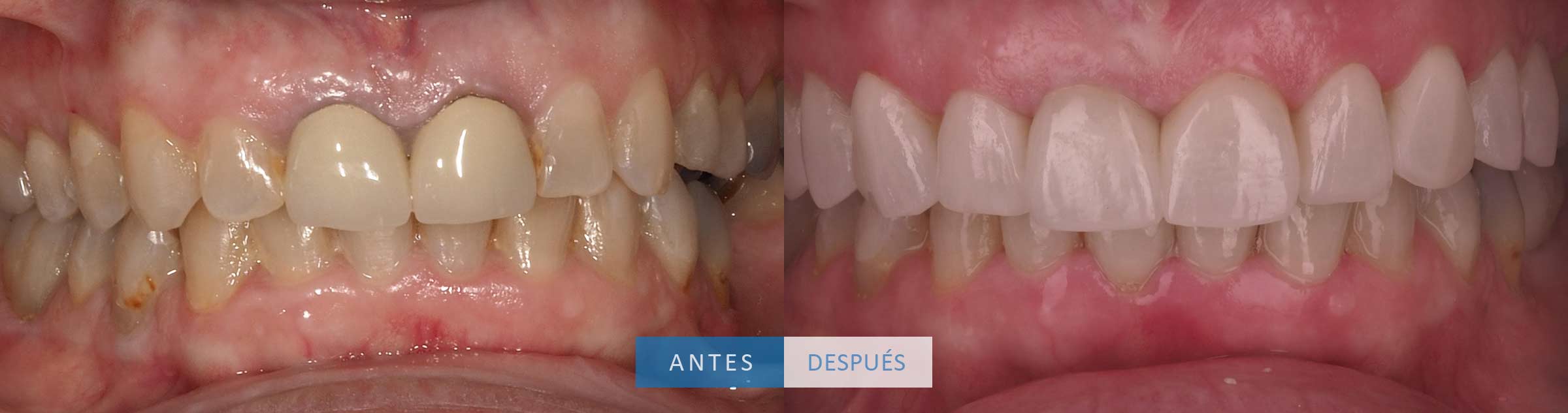 Resultado final coronas dentales