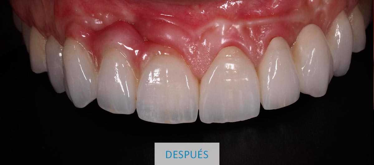 Resultado final coronas dentales