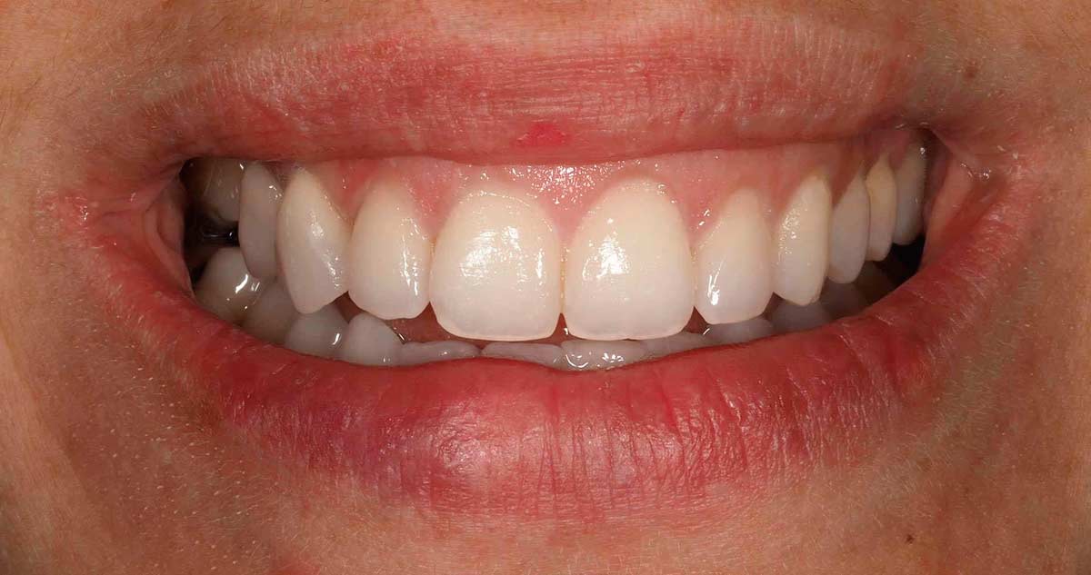 Sonrisa final paciente con carillas dentales