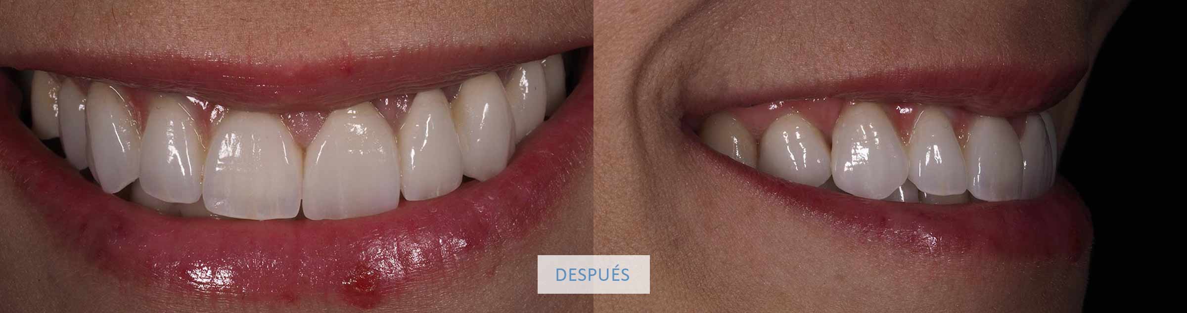 Resultado sonrisa final caso clínico coronas dentales
