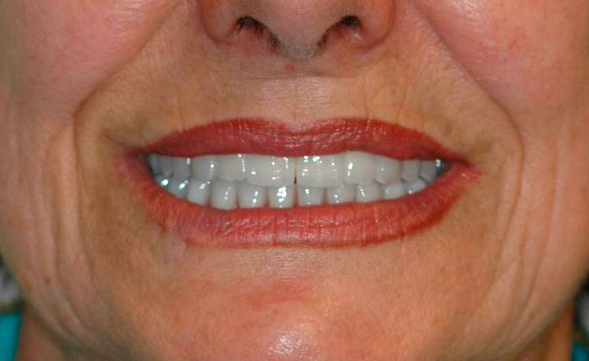 Sonrisa post tratamiento dental