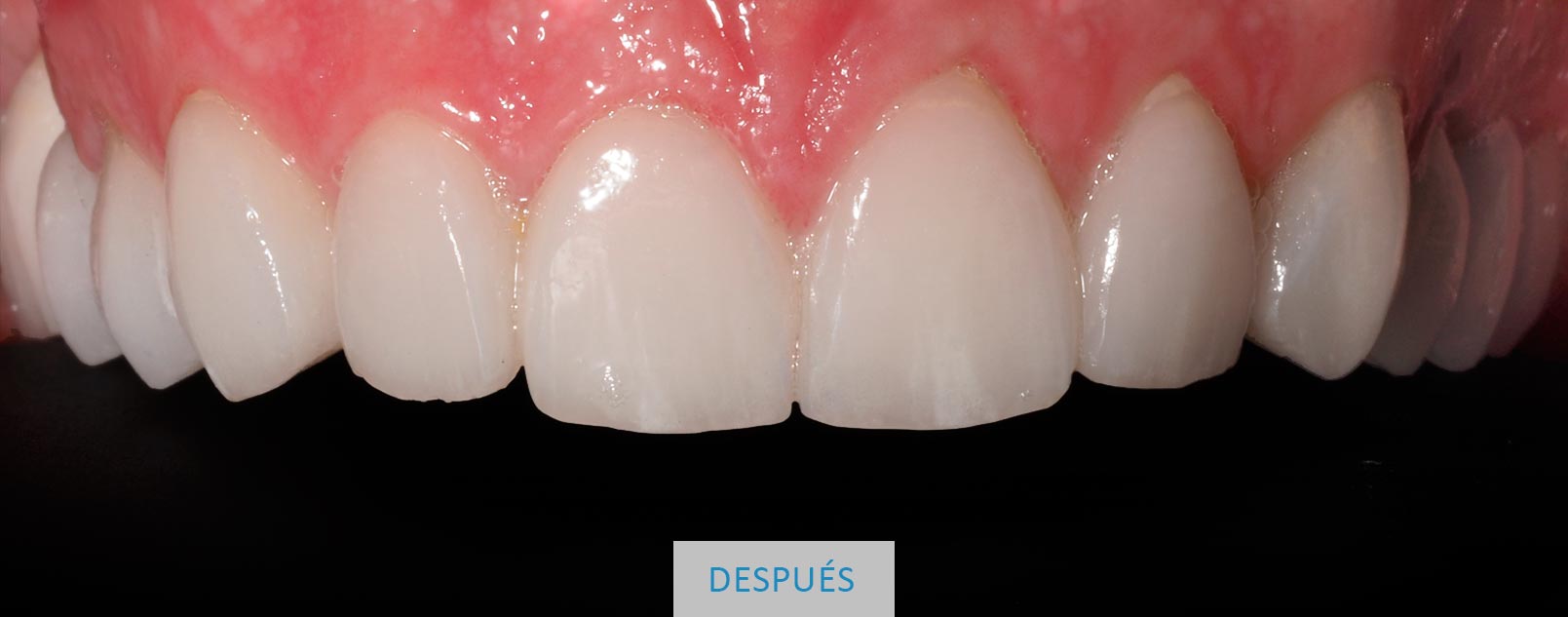 Resultado final caso clínico carillas feldespáticas