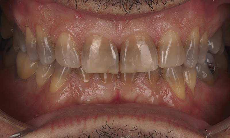 Caso clínico blanqueamiento dental antes