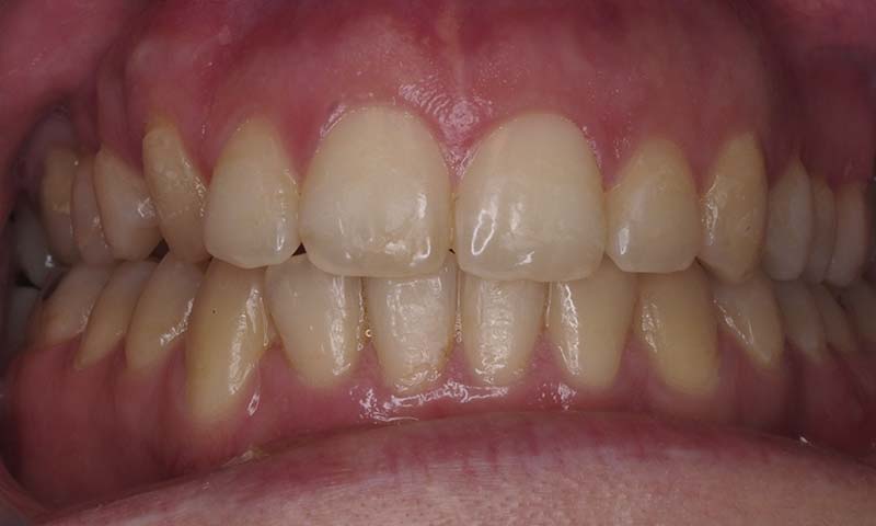 Blanqueamiento dental y reconstrucción con composite antes