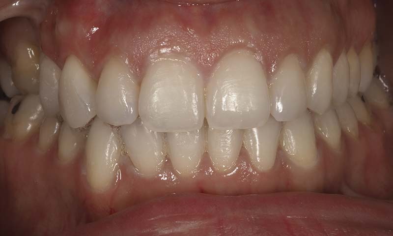 Blanqueamiento dental y reconstrucción con composite despues