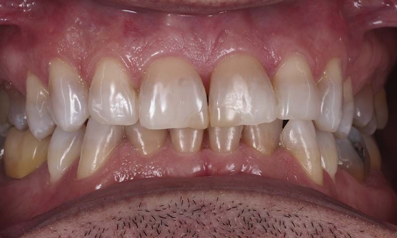 Caso clínico blanqueamiento dental despues