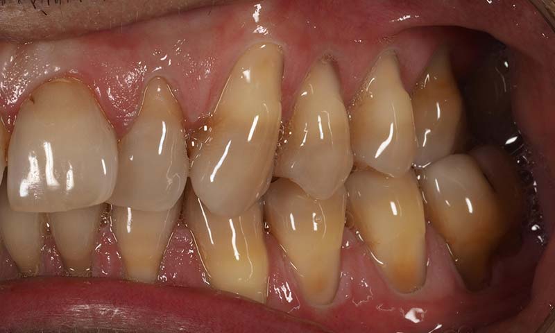 injerto gingival conectivo antes