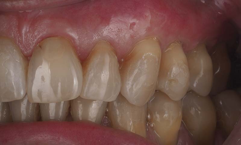 injerto gingival conectivo despues