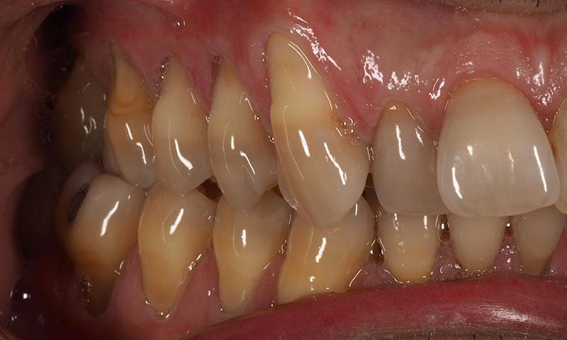 injerto gingival conectivo antes