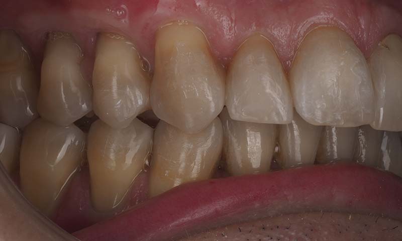 injerto gingival conectivo despues