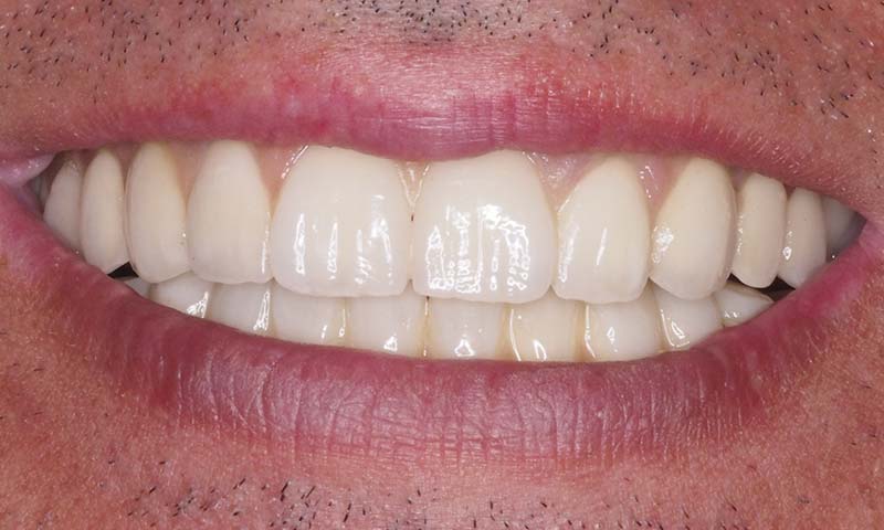 Prótesis dental completa sobre implantes antes