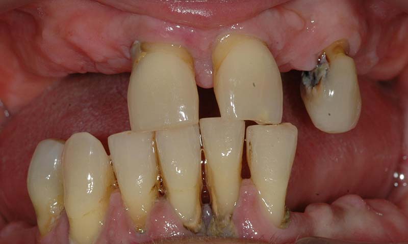 Prótesis fija emergente en cerámica sobre implantes dentales e híbrida inferior antes