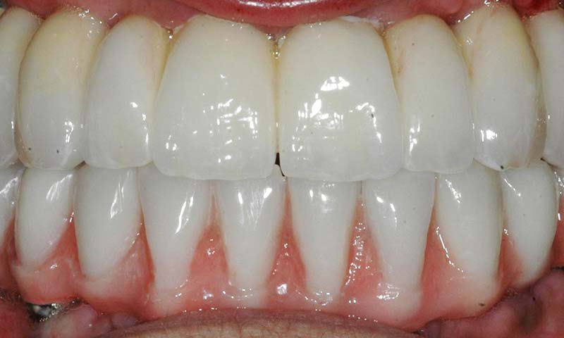 Prótesis fija emergente en cerámica sobre implantes dentales e híbrida inferior antes