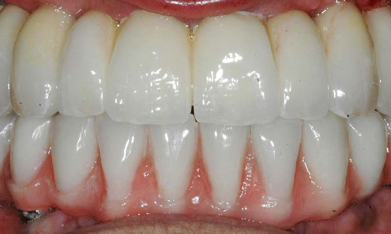 Prótesis fija emergente en cerámica sobre implantes dentales e híbrida inferior antes