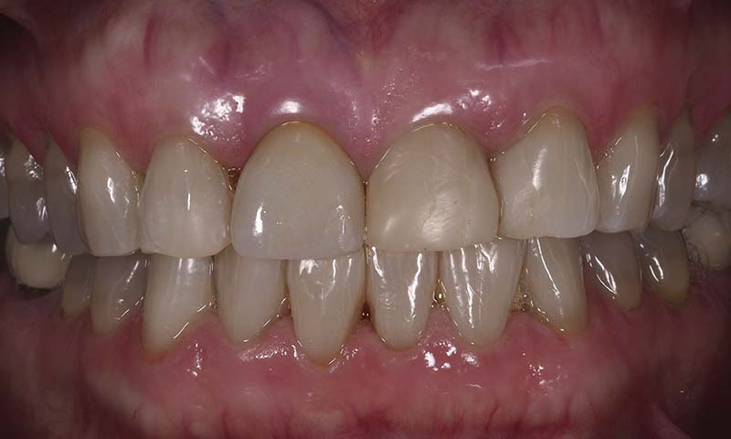 Caso clínico carillas dentales feldespáticas antes
