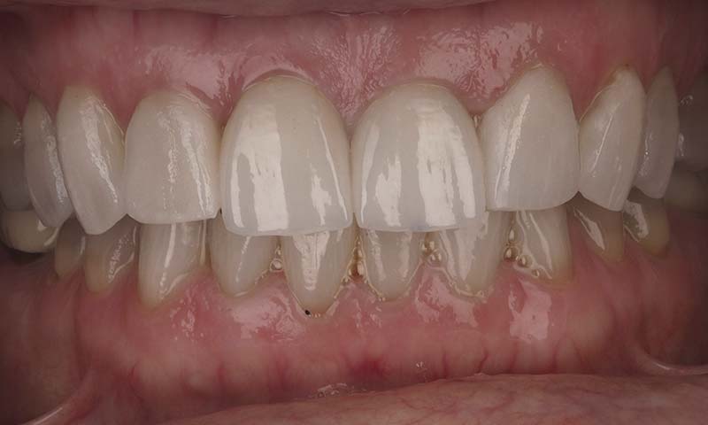 Caso clínico carillas dentales feldespáticas después