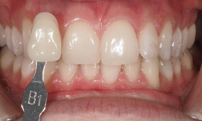 Blanqueamiento dental paso a paso despues