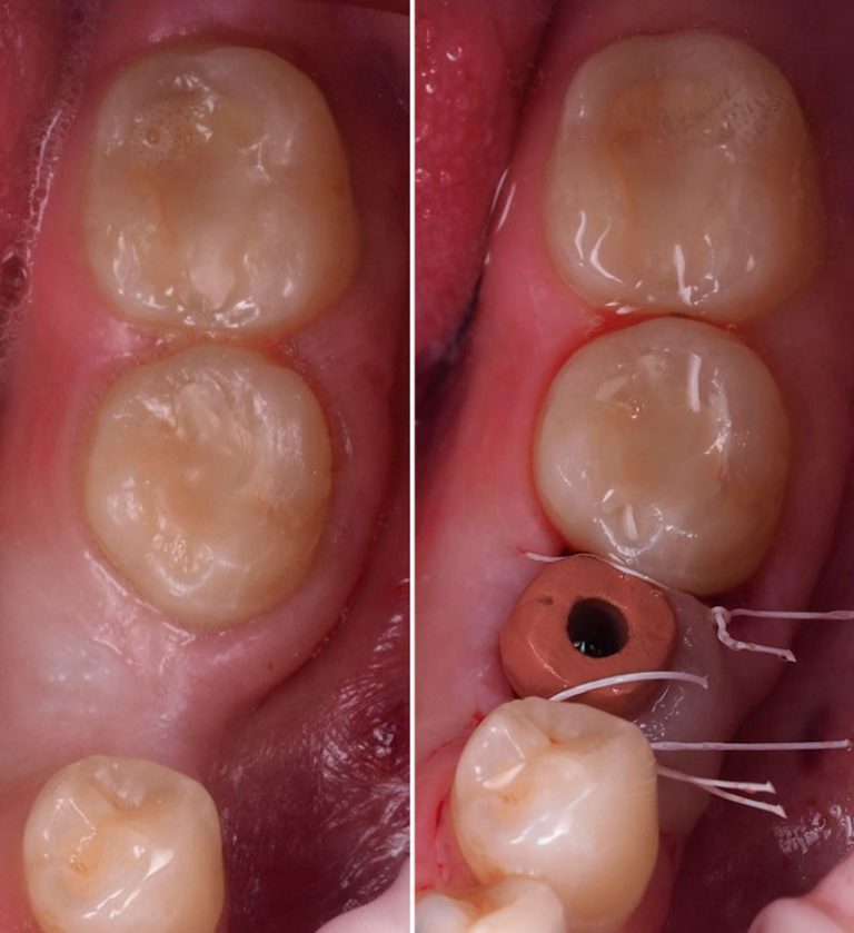 autotransplante dental cirugia