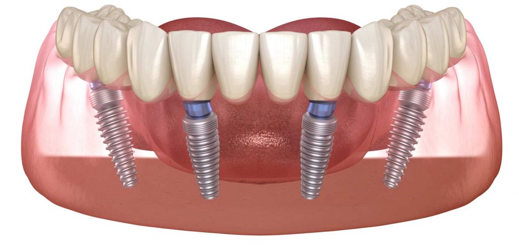 Implantes dentales clínica Loscos
