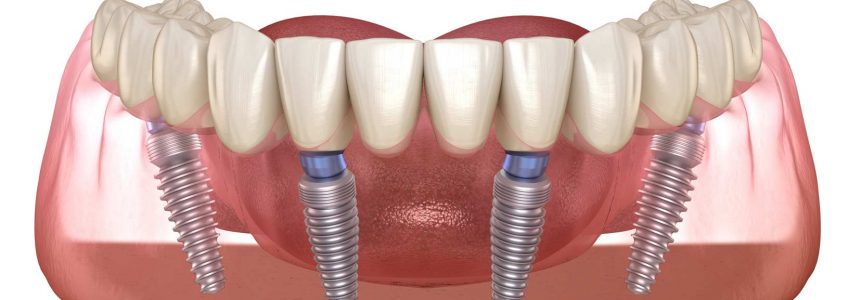 Implantes dentales éxito Loscos