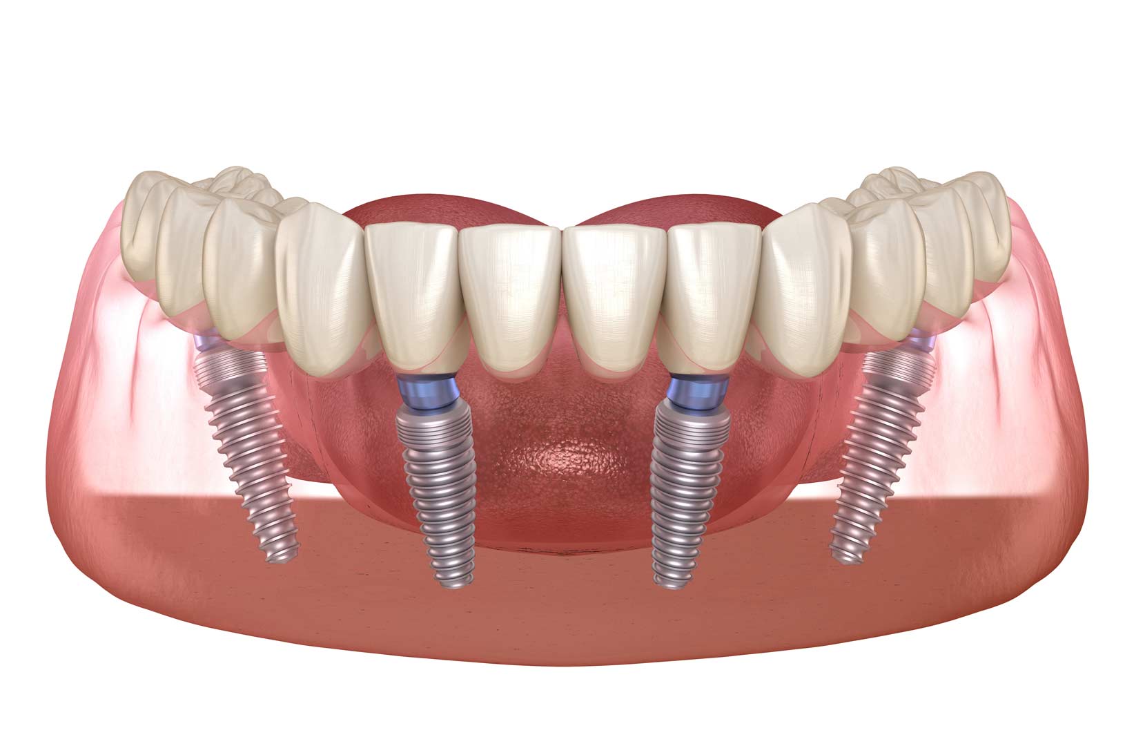 Implantes dentales éxito Loscos