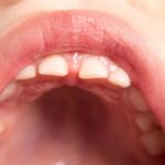 ¿A qué se deben las manchas blancas en los dientes de los niños?