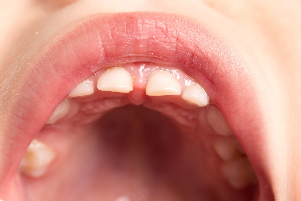 dientes-leche-niños