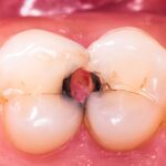 Caries interproximales: cómo detectarlas antes de que duelan