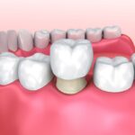 Corona provisional: cuánto tiempo se utiliza y cuidados recomendados