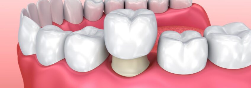 colocación de corona provisional